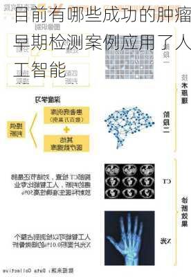 目前有哪些成功的肿瘤早期检测案例应用了人工智能